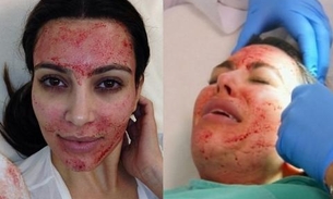 Kim Kardashian faz tratamento de beleza com sangue